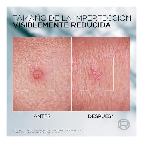 Men Expert Derma Control S.O.S Pimple Paste