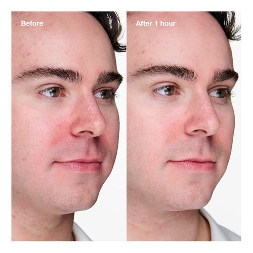 Anti-Blemish Solutions Clearing Gel